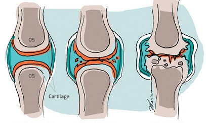tratamentul artrozei 2 3 grade a articulației genunchiului