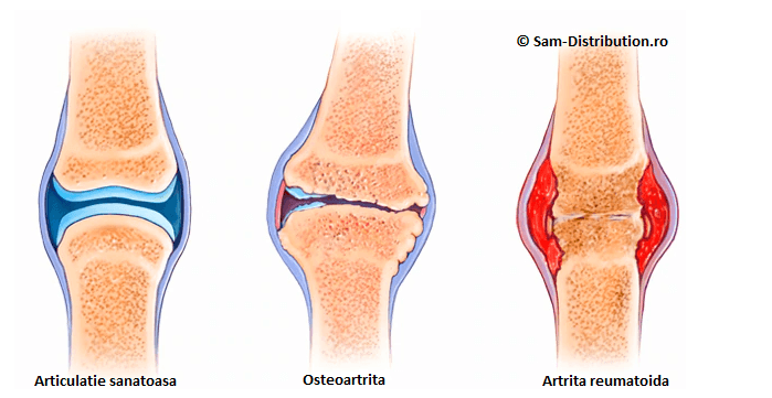 artroza articulațiilor mijlocii ale piciorului