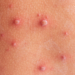 Varice sau vene varicoase: cauze, simptome si tratament | Bioclinica